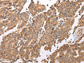 The image on the left is immunohistochemistry of paraffin-embedded Human prostate cancer tissue using CSB-PA569709(UQCRC2 Antibody) at dilution 1/25, on the right is treated with fusion protein. (Original magnification: ×200)