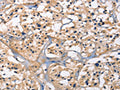The image on the left is immunohistochemistry of paraffin-embedded Human thyroid cancer tissue using CSB-PA569917(CAPZA2 Antibody) at dilution 1/15, on the right is treated with fusion protein. (Original magnification: ×200)