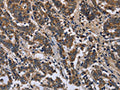 The image is immunohistochemistry of paraffin-embedded Human liver cancer tissue using CSB-PA570140(FRK Antibody) at dilution 1/50. (Original magnification: ×200)