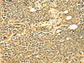 The image on the left is immunohistochemistry of paraffin-embedded Human ovarian cancer tissue using CSB-PA570366(ECE2 Antibody) at dilution 1/25, on the right is treated with fusion protein. (Original magnification: ×200)