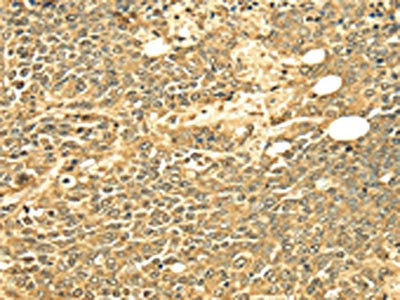 The image on the left is immunohistochemistry of paraffin-embedded Human ovarian cancer tissue using CSB-PA570366(ECE2 Antibody) at dilution 1/25, on the right is treated with fusion protein. (Original magnification: ×200)