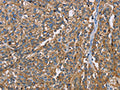 The image on the left is immunohistochemistry of paraffin-embedded Human esophagus cancer tissue using CSB-PA570608(BSG Antibody) at dilution 1/60, on the right is treated with fusion protein. (Original magnification: ×200)