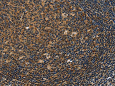 The image on the left is immunohistochemistry of paraffin-embedded Human tonsil tissue using CSB-PA570795(IRF9 Antibody) at dilution 1/50, on the right is treated with fusion protein. (Original magnification: ×200)
