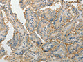 The image on the left is immunohistochemistry of paraffin-embedded Human thyroid cancer tissue using CSB-PA571057(MPZ Antibody) at dilution 1/5, on the right is treated with fusion protein. (Original magnification: ×200)