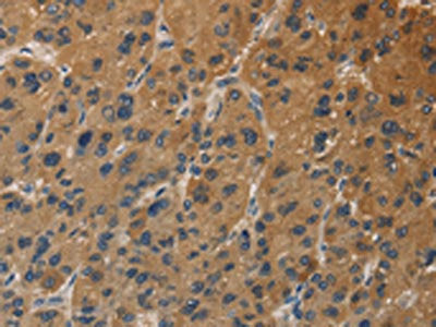 The image on the left is immunohistochemistry of paraffin-embedded Human liver cancer tissue using CSB-PA571416(DUSP23 Antibody) at dilution 1/30, on the right is treated with fusion protein. (Original magnification: ×200)