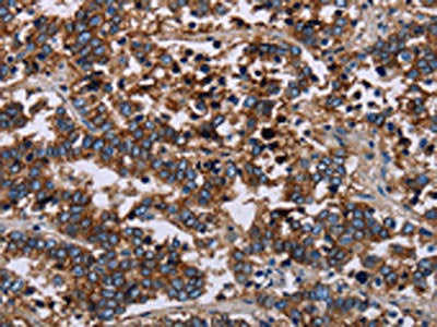 The image on the left is immunohistochemistry of paraffin-embedded Human liver cancer tissue using CSB-PA571561(F11R Antibody) at dilution 1/40, on the right is treated with fusion protein. (Original magnification: ×200)