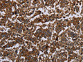 The image on the left is immunohistochemistry of paraffin-embedded Human liver cancer tissue using CSB-PA571650(HOMER2 Antibody) at dilution 1/30, on the right is treated with fusion protein. (Original magnification: ×200)