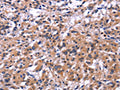 The image on the left is immunohistochemistry of paraffin-embedded Human thyroid cancer tissue using CSB-PA571675(SIGLEC5 Antibody) at dilution 1/30, on the right is treated with fusion protein. (Original magnification: ×200)