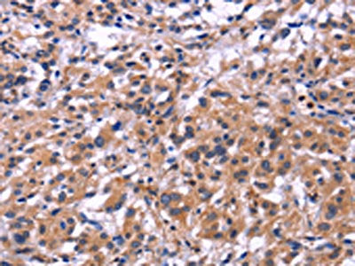 The image on the left is immunohistochemistry of paraffin-embedded Human thyroid cancer tissue using CSB-PA571675(SIGLEC5 Antibody) at dilution 1/30, on the right is treated with fusion protein. (Original magnification: ×200)