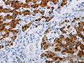 The image on the left is immunohistochemistry of paraffin-embedded Human liver cancer tissue using CSB-PA571870(NDUFA12 Antibody) at dilution 1/50, on the right is treated with synthetic peptide. (Original magnification: ×200)