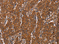 The image on the left is immunohistochemistry of paraffin-embedded Human gastic cancer tissue using CSB-PA572419(DCTN6 Antibody) at dilution 1/60, on the right is treated with fusion protein. (Original magnification: ×200)