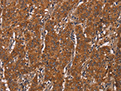 The image on the left is immunohistochemistry of paraffin-embedded Human gastic cancer tissue using CSB-PA572419(DCTN6 Antibody) at dilution 1/60, on the right is treated with fusion protein. (Original magnification: ×200)
