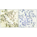 Immunohistochemical analysis of paraffin-embedded human breast carcinoma tissue using DNA-PK antibody.