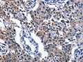 The image on the left is immunohistochemistry of paraffin-embedded Human lung cancer tissue using CSB-PA572641(NAT8 Antibody) at dilution 1/50, on the right is treated with fusion protein. (Original magnification: ×200)