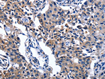 The image on the left is immunohistochemistry of paraffin-embedded Human lung cancer tissue using CSB-PA572641(NAT8 Antibody) at dilution 1/50, on the right is treated with fusion protein. (Original magnification: ×200)