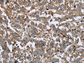 The image on the left is immunohistochemistry of paraffin-embedded Human liver cancer tissue using CSB-PA573035(FCAR Antibody) at dilution 1/20, on the right is treated with fusion protein. (Original magnification: ×200)