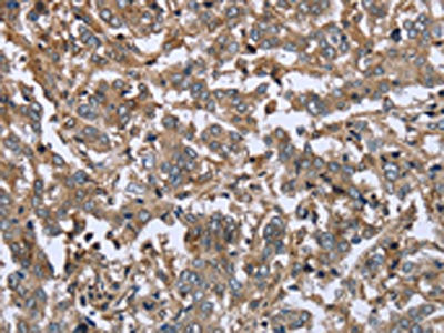 The image on the left is immunohistochemistry of paraffin-embedded Human liver cancer tissue using CSB-PA573035(FCAR Antibody) at dilution 1/20, on the right is treated with fusion protein. (Original magnification: ×200)
