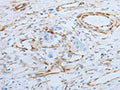 The image on the left is immunohistochemistry of paraffin-embedded Human esophagus cancer tissue using CSB-PA573580(SPINT1 Antibody) at dilution 1/25, on the right is treated with fusion protein. (Original magnification: ×200)