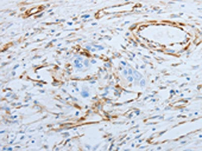 The image on the left is immunohistochemistry of paraffin-embedded Human esophagus cancer tissue using CSB-PA573580(SPINT1 Antibody) at dilution 1/25, on the right is treated with fusion protein. (Original magnification: ×200)