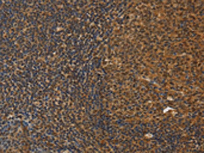 The image on the left is immunohistochemistry of paraffin-embedded Human tonsil tissue using CSB-PA574764(DAB2 Antibody) at dilution 1/30, on the right is treated with fusion protein. (Original magnification: ×200)