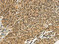 The image on the left is immunohistochemistry of paraffin-embedded Human lung cancer tissue using CSB-PA575331(PSMD10 Antibody) at dilution 1/40, on the right is treated with fusion protein. (Original magnification: ×200)