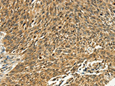 The image on the left is immunohistochemistry of paraffin-embedded Human lung cancer tissue using CSB-PA575331(PSMD10 Antibody) at dilution 1/40, on the right is treated with fusion protein. (Original magnification: ×200)