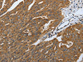 The image on the left is immunohistochemistry of paraffin-embedded Human ovarian cancer tissue using CSB-PA575557(DLG4 Antibody) at dilution 1/40, on the right is treated with synthetic peptide. (Original magnification: ×200)
