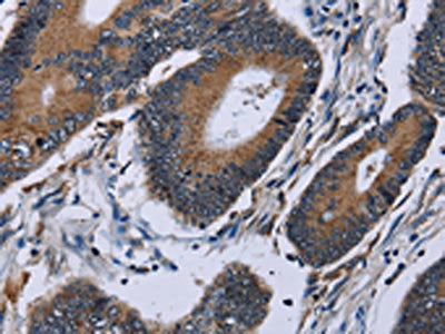 The image on the left is immunohistochemistry of paraffin-embedded Human colon cancer tissue using CSB-PA575590(IPO4 Antibody) at dilution 1/50, on the right is treated with fusion protein. (Original magnification: ×200)
