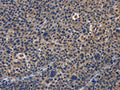 The image on the left is immunohistochemistry of paraffin-embedded Human liver cancer tissue using CSB-PA575950(PRKCD Antibody) at dilution 1/30, on the right is treated with fusion protein. (Original magnification: ×200)