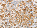 The image on the left is immunohistochemistry of paraffin-embedded Human thyroid cancer tissue using CSB-PA576064(NPPB Antibody) at dilution 1/30, on the right is treated with fusion protein. (Original magnification: ×200)