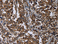 The image on the left is immunohistochemistry of paraffin-embedded Human liver cancer tissue using CSB-PA576137(DNAJC15 Antibody) at dilution 1/40, on the right is treated with fusion protein. (Original magnification: ×200)