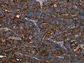 The image on the left is immunohistochemistry of paraffin-embedded Human ovarian cancer tissue using CSB-PA576264(HMGCL Antibody) at dilution 1/30, on the right is treated with fusion protein. (Original magnification: ×200)