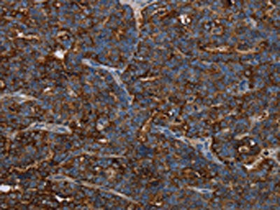 The image on the left is immunohistochemistry of paraffin-embedded Human ovarian cancer tissue using CSB-PA576264(HMGCL Antibody) at dilution 1/30, on the right is treated with fusion protein. (Original magnification: ×200)