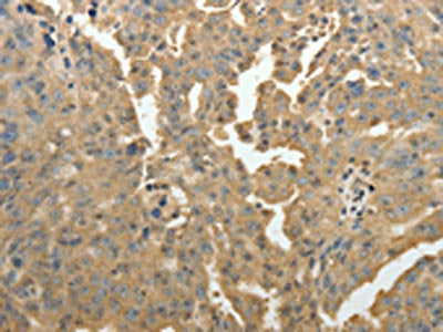 The image on the left is immunohistochemistry of paraffin-embedded Human ovarian cancer tissue using CSB-PA576314(PSMD9 Antibody) at dilution 1/50, on the right is treated with fusion protein. (Original magnification: ×200)