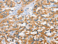 The image on the left is immunohistochemistry of paraffin-embedded Human thyroid cancer tissue using CSB-PA576532(CXCL14 Antibody) at dilution 1/40, on the right is treated with fusion protein. (Original magnification: ×200)