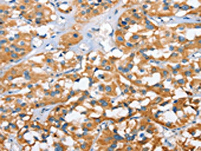 The image on the left is immunohistochemistry of paraffin-embedded Human thyroid cancer tissue using CSB-PA576532(CXCL14 Antibody) at dilution 1/40, on the right is treated with fusion protein. (Original magnification: ×200)