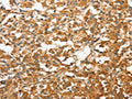 The image on the left is immunohistochemistry of paraffin-embedded Human thyroid cancer tissue using CSB-PA576592(ANXA9 Antibody) at dilution 1/30, on the right is treated with fusion protein. (Original magnification: ×200)