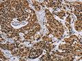 The image on the left is immunohistochemistry of paraffin-embedded Human cervical cancer tissue using CSB-PA576836(CCL21 Antibody) at dilution 1/40, on the right is treated with fusion protein. (Original magnification: ×200)