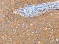 The image on the left is immunohistochemistry of paraffin-embedded Human cervical cancer tissue using CSB-PA577006(ACY3 Antibody) at dilution 1/25, on the right is treated with fusion protein. (Original magnification: ×200)