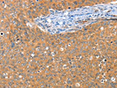 The image on the left is immunohistochemistry of paraffin-embedded Human cervical cancer tissue using CSB-PA577006(ACY3 Antibody) at dilution 1/25, on the right is treated with fusion protein. (Original magnification: ×200)