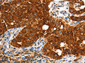 The image on the left is immunohistochemistry of paraffin-embedded Human lung cancer tissue using CSB-PA577110(VWA5A Antibody) at dilution 1/60, on the right is treated with fusion protein. (Original magnification: ×200)