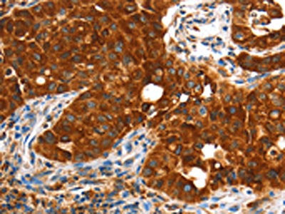 The image on the left is immunohistochemistry of paraffin-embedded Human lung cancer tissue using CSB-PA577110(VWA5A Antibody) at dilution 1/60, on the right is treated with fusion protein. (Original magnification: ×200)