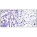 Immunohistochemistry analysis of paraffin-embedded human lung carcinoma tissue using PIAS4 antibody.