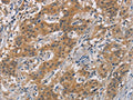 The image is immunohistochemistry of paraffin-embedded Human gastic cancer tissue using CSB-PA577711(AXIN2 Antibody) at dilution 1/20. (Original magnification: ×200)