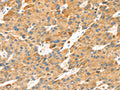 The image on the left is immunohistochemistry of paraffin-embedded Human liver cancer tissue using CSB-PA577745(TNFSF15 Antibody) at dilution 1/30, on the right is treated with synthetic peptide. (Original magnification: ×200)