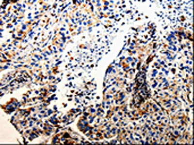 The image on the left is immunohistochemistry of paraffin-embedded Human lung cancer tissue using CSB-PA577887(CTSZ Antibody) at dilution 1/25, on the right is treated with fusion protein. (Original magnification: ×200)
