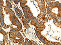 The image on the left is immunohistochemistry of paraffin-embedded Human colon cancer tissue using CSB-PA578056(MAP1LC3A Antibody) at dilution 1/15, on the right is treated with fusion protein. (Original magnification: ×200)