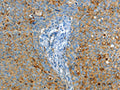 The image on the left is immunohistochemistry of paraffin-embedded Human cervical cancer tissue using CSB-PA578122(ASAH1 Antibody) at dilution 1/50, on the right is treated with fusion protein. (Original magnification: ×200)