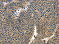 The image on the left is immunohistochemistry of paraffin-embedded Human liver cancer tissue using CSB-PA578311(COL4A2 Antibody) at dilution 1/70, on the right is treated with synthetic peptide. (Original magnification: ×200)