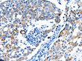 The image on the left is immunohistochemistry of paraffin-embedded Human breast cancer tissue using CSB-PA578328(POMC Antibody) at dilution 1/30, on the right is treated with synthetic peptide. (Original magnification: ×200)